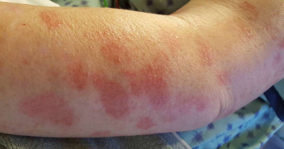 Gráfico ilustrativo sobre as causas, sintomas e tratamento da hanseníase.