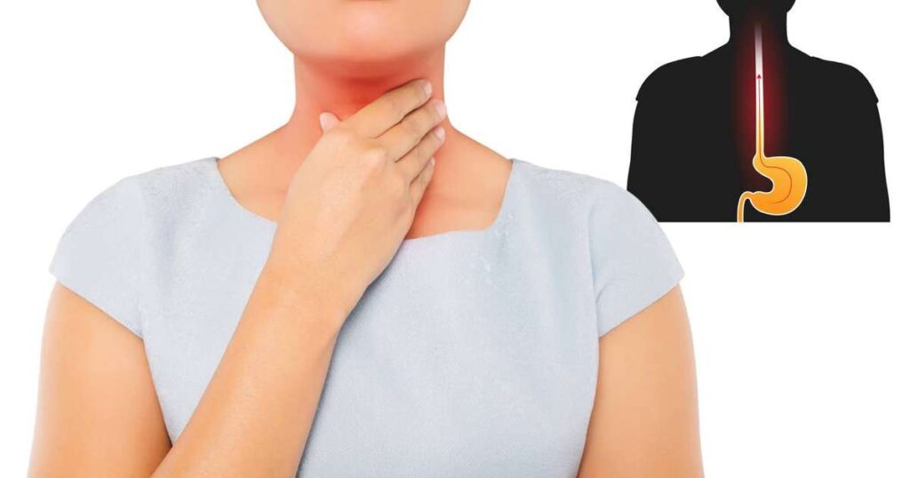 Diagrama mostrando o refluxo gastroesofágico e seus sintomas