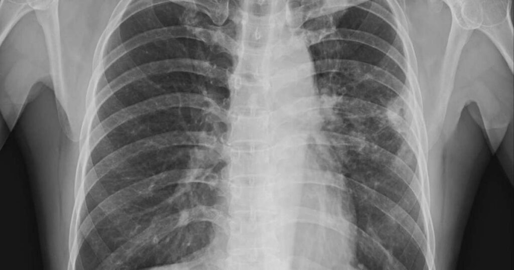 Inteligência artificial em hospitais de Brasília para diagnóstico precoce de câncer