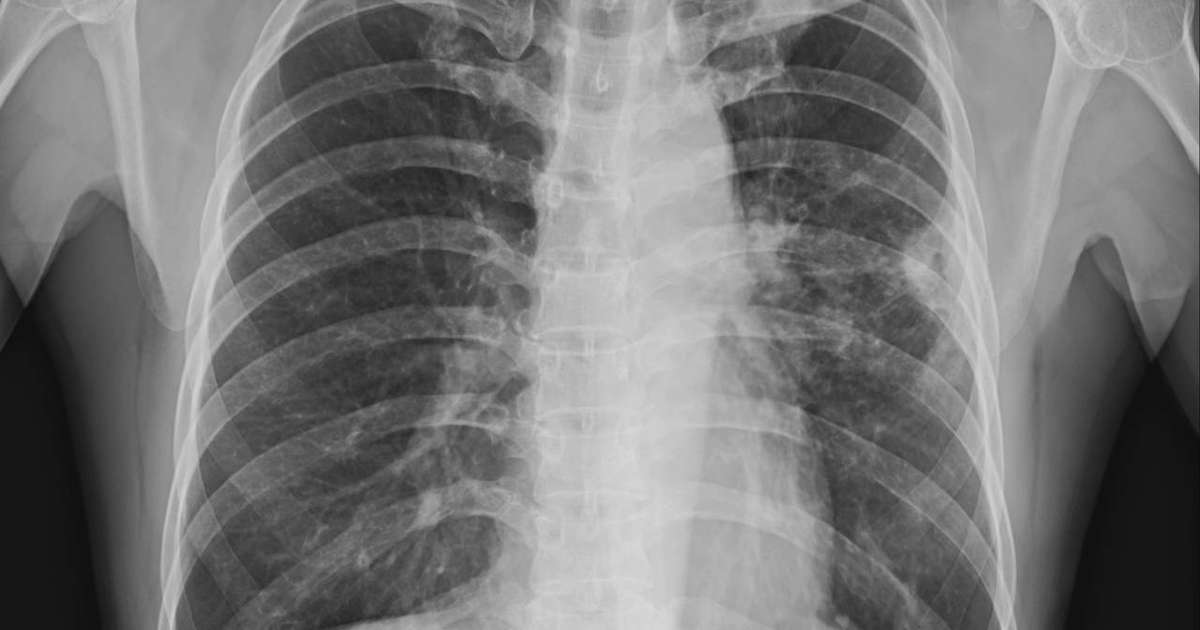 Inteligência artificial em hospitais de Brasília para diagnóstico precoce de câncer